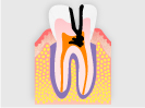 C3：重度のむし歯