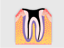 C4：最重度のむし歯