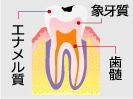 C1：軽度のむし歯