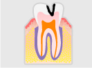 C2：中度のむし歯