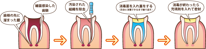 根管治療の流れ