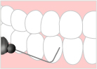 歯周ポケット検査