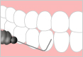 C3：重度のむし歯