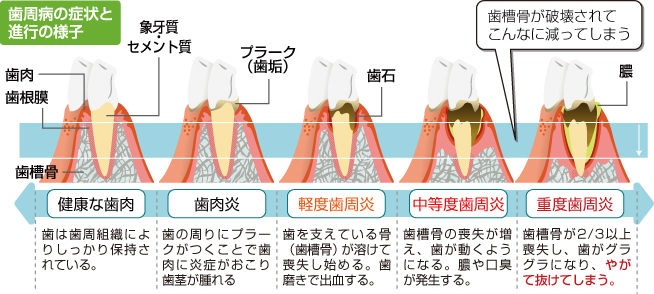 歯周病の進行の様子