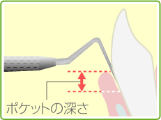 ポケット検査